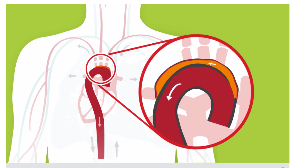 Aortic dissection image